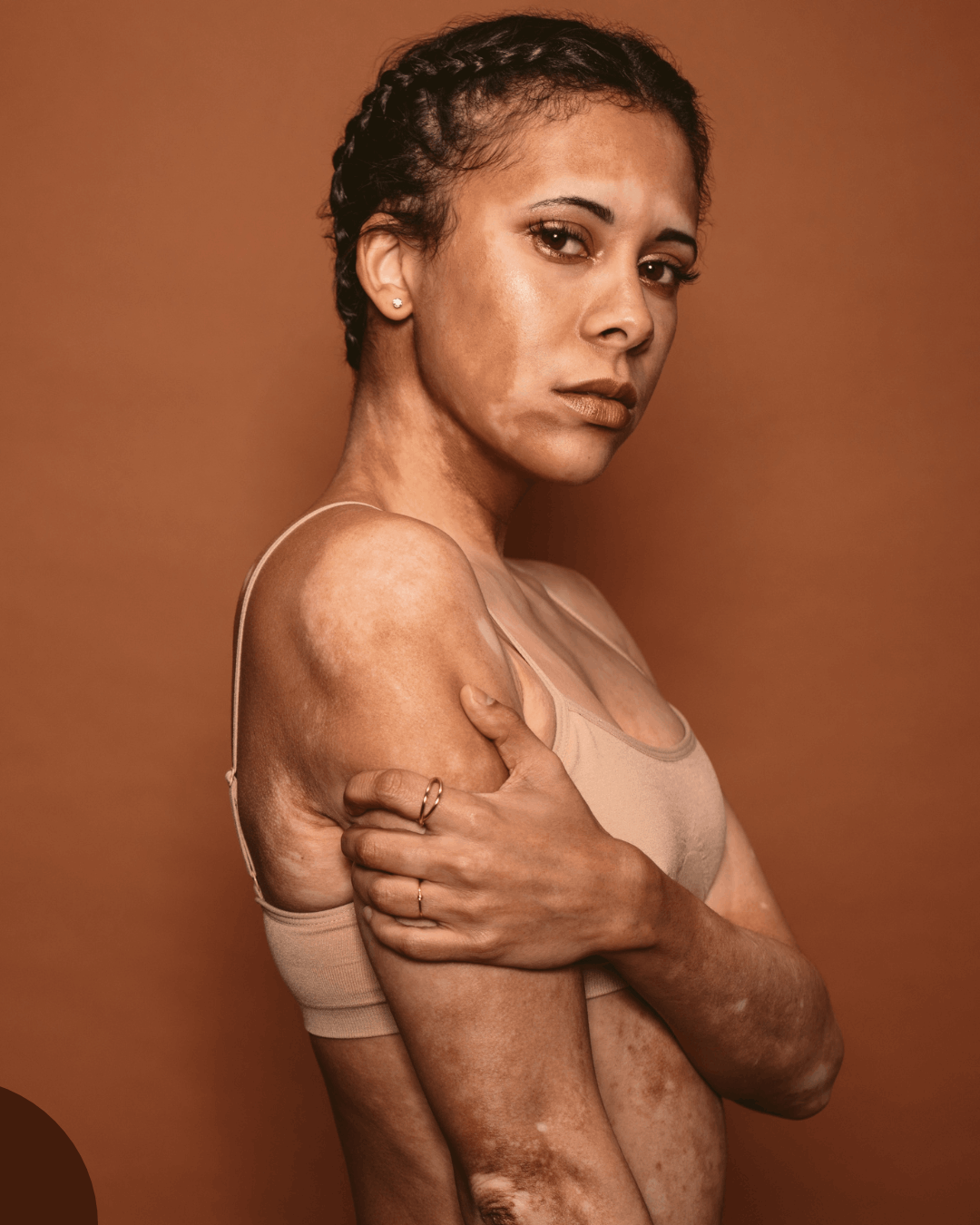 vitiligo treatment 